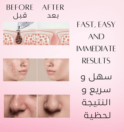 Facial Vacuum Cleaner